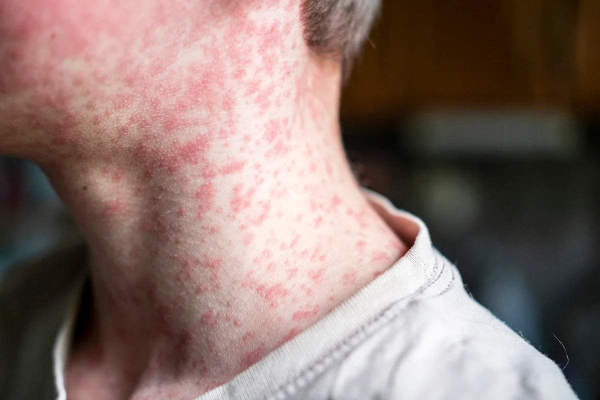 Sarampo nos EUA: Pensilvânia registra mais 55 novos casos da doença