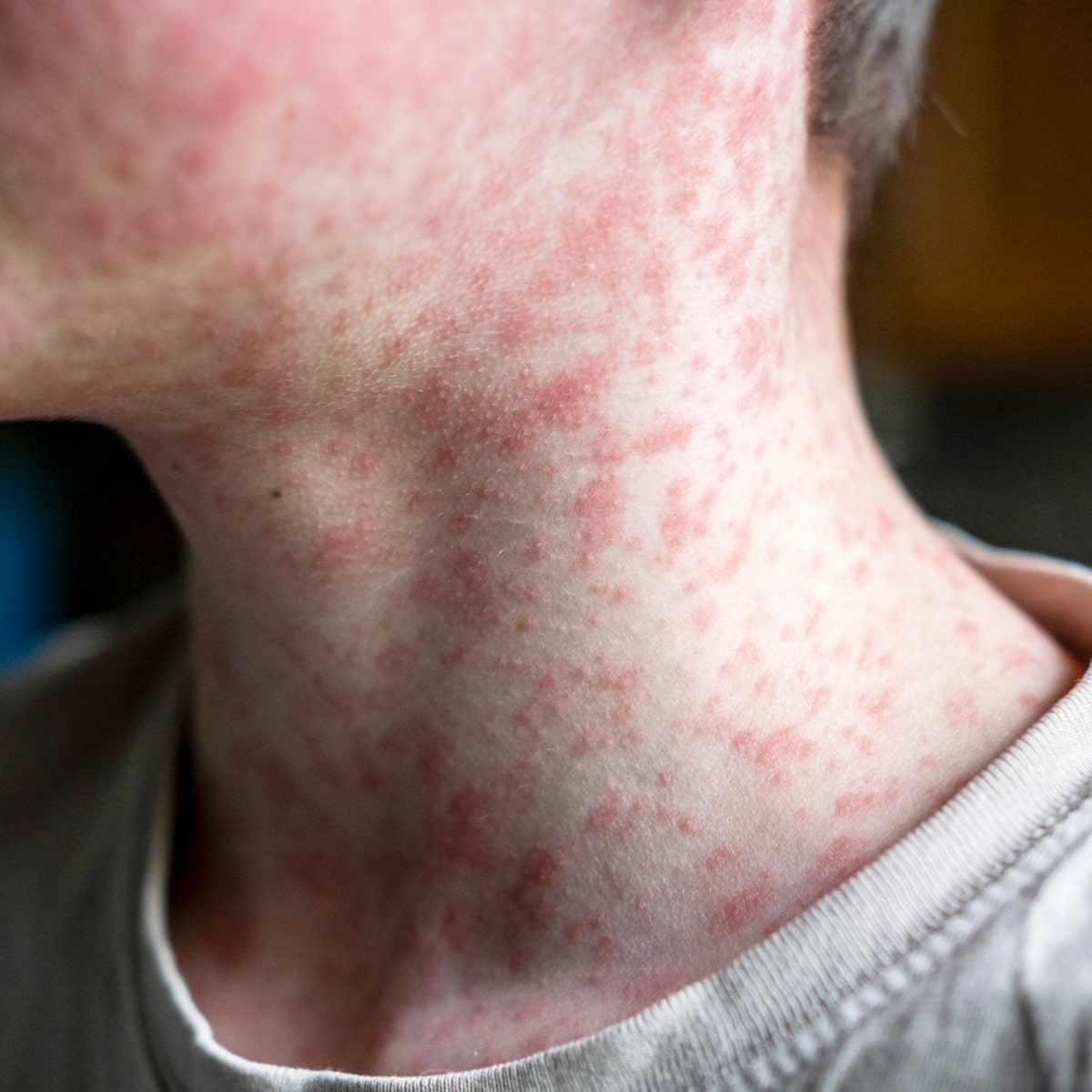 EUA confirmam 5ª morte por sarampo em 2026; queda na vacinação levou país ao pior surto em 35 anos